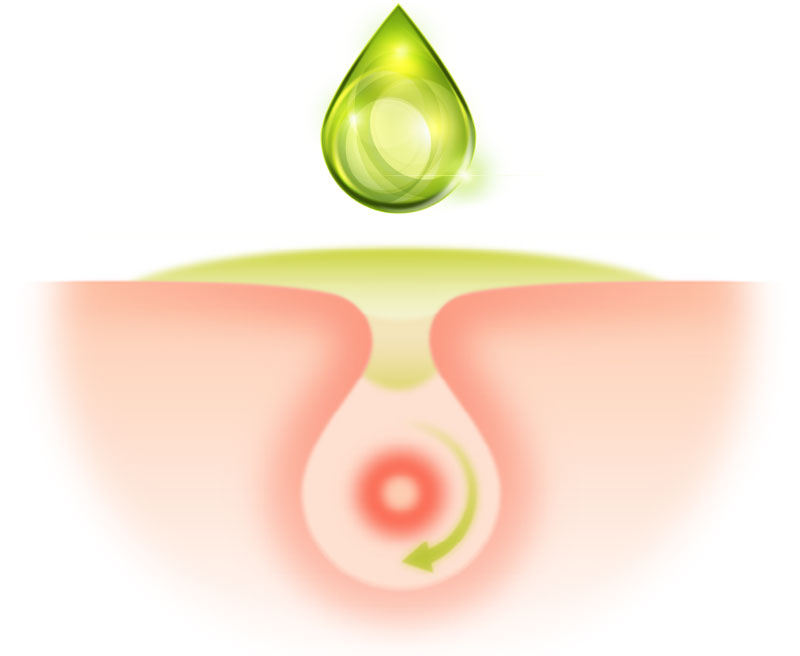How does Tea Tree Oil work on Pimples | Thursday Plantation | Acne & Skin Care | Canada